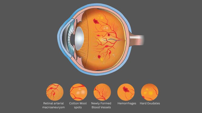 Diabetic Retinopathy